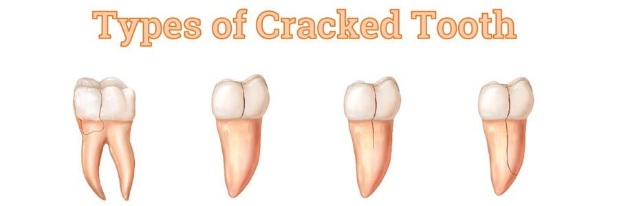 types of cracked tooth vancouver