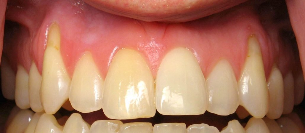 Jaw and Gum Resorption, Brush & Floss Dental Center