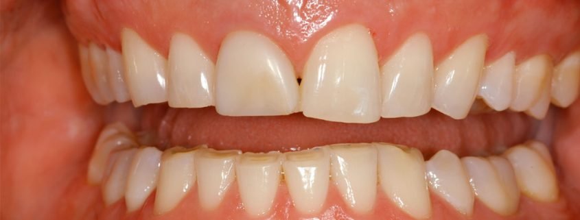 vancouver teeth grinding