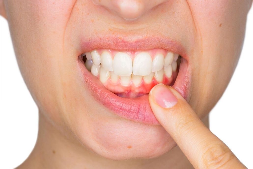 Gum Disease: Symptoms, Causes, and Prevention