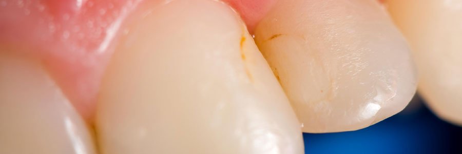east vancouver teeth discoloration